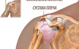 Лечение тендинита плеча