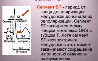 Причины и признаки депрессии сегмента ST