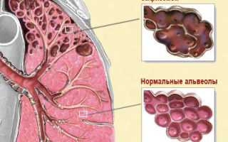 Признаки эмфиземы легких: основные жалобы и диагностические показатели