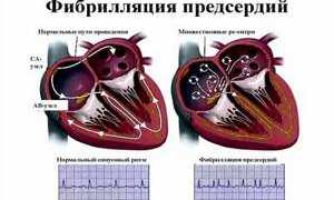 Лечение мерцательной аритмии сердца народными средствами