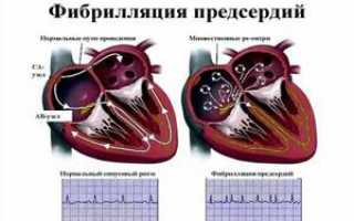 Лечение мерцательной аритмии сердца народными средствами