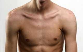 Деформация грудной клетки: чем лечить и как предотвратить?