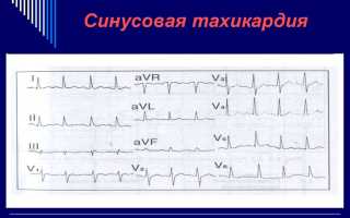 Синусовая тахикардия — причины, симптомы, лечение и профилактика