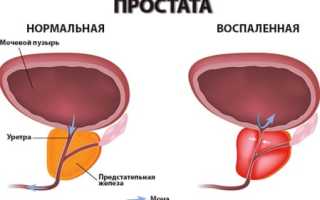 Можно ли вылечить хронический простатит раз и навсегда?