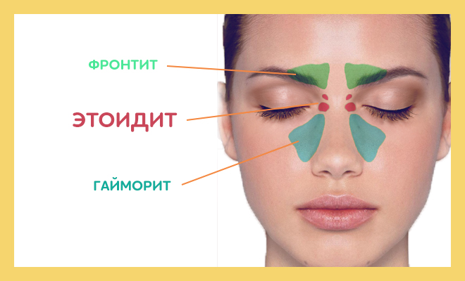 Фронтит