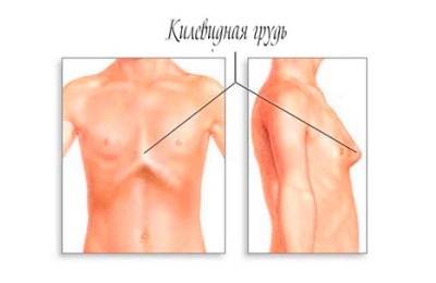 Килевидная грудь