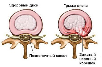 Грыжа на позвоночнике