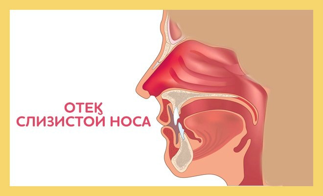 Отек носоглотки