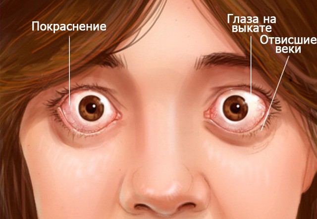 Гипертиреоз