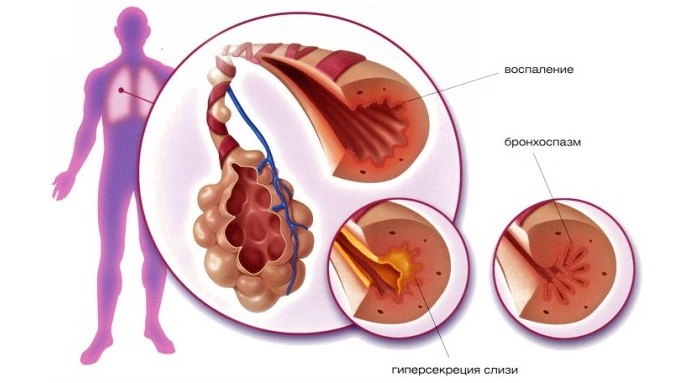 Бронхиальная астма