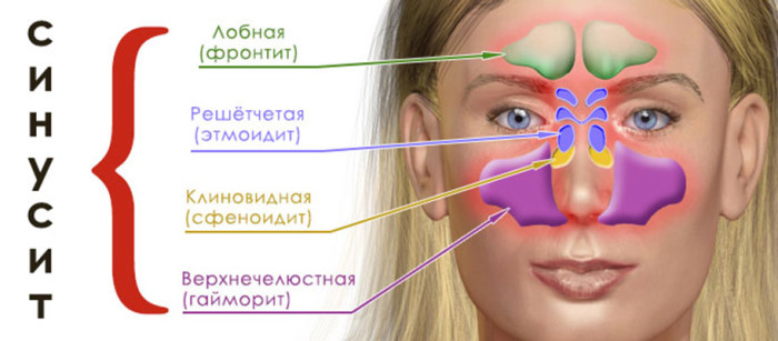 Виды синусита