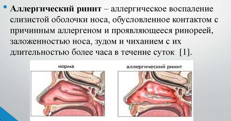 Аллергический ринит