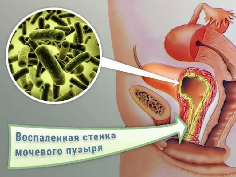 бактериальный цистит лечение у женщин