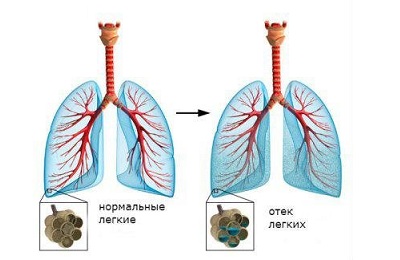 Отек легкого