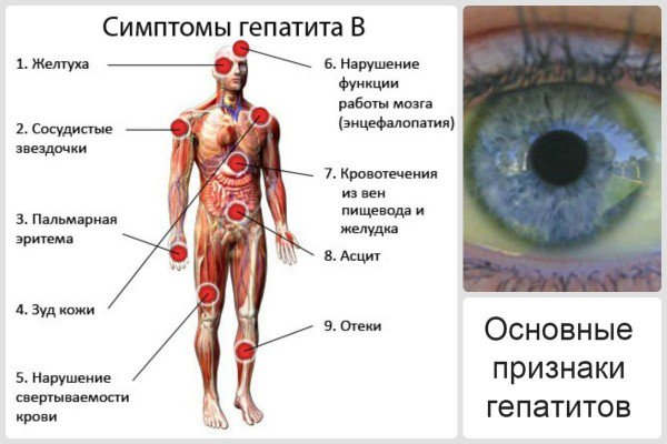 Симптомы гепатита