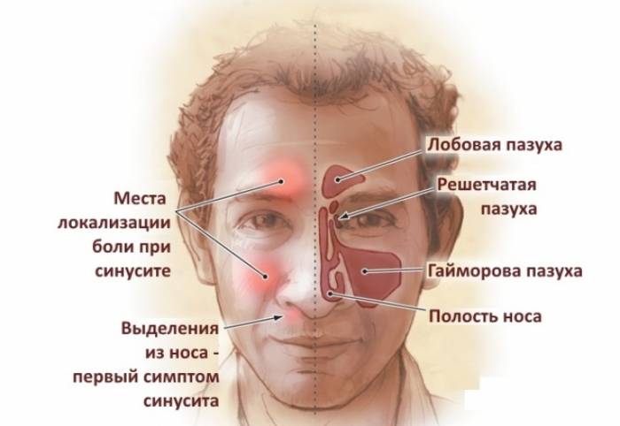 Синусит