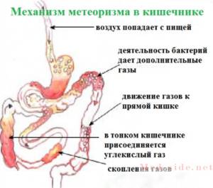 Причины метеоризма: что делать при вздутии живота