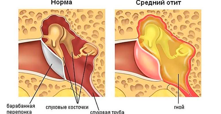 Воспаление уха