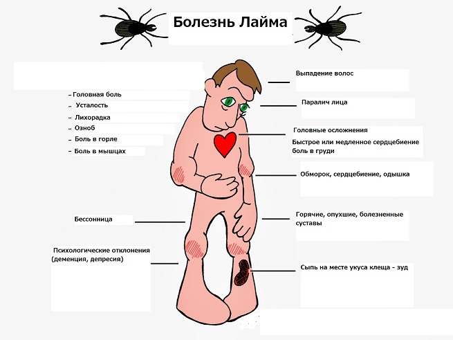 Лечение болезни Лайма антибиотиками. Профилактика заболевания до укуса клеща.