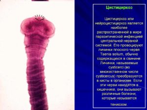 Цистицеркоз