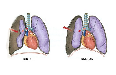 Пневмоторакс