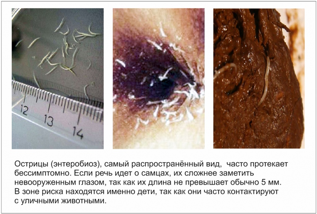 Энтеробиоз