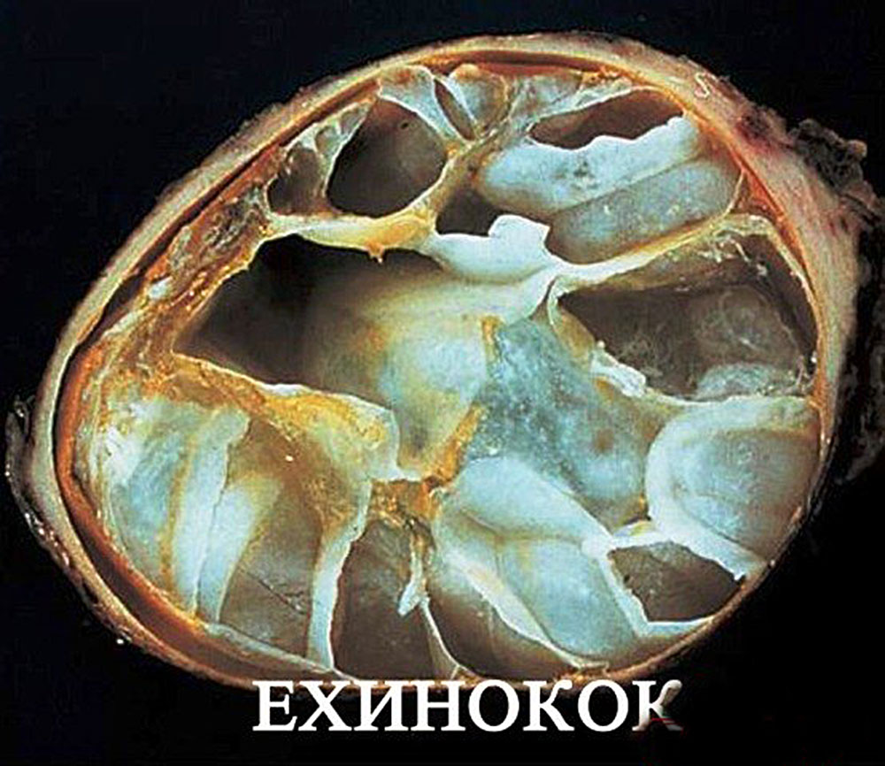 Эхинококки