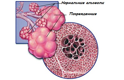 Поврежденные бронхи