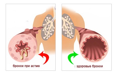 Бронхиальная астма