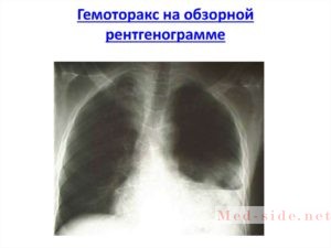 Что такое гемоторакс, основные причины выхода крови в плевральную полость. Опасности и способы купирования неотложного состояния