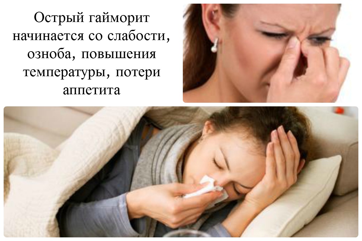 Симптомы острого гайморита