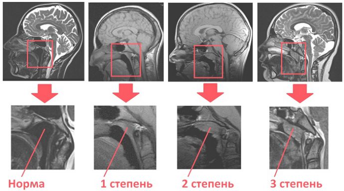Степени увеличения аденоидов