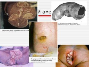 Амебиаз у детей. Основные причины и симптомы у детей на ранних этапах болезни