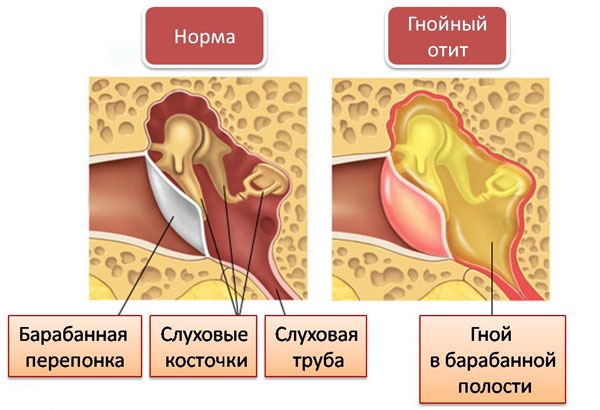 Отит