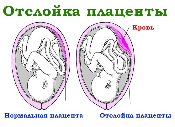 Отслойка плаценты
