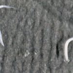 Из-за чего от глистов появляются прыщи