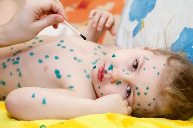 Осложнения после ветрянки у детей