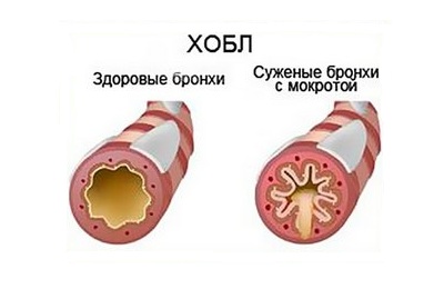 Больные бронхи