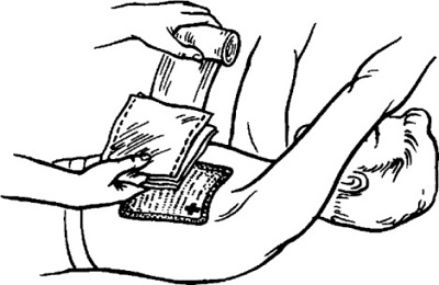 Наложение повязки