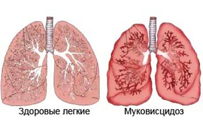 Респираторный муковисцидоз