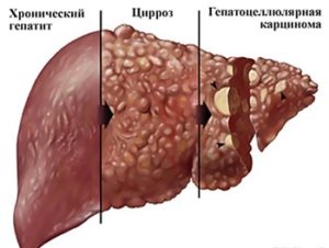 Современные методы лечения гепатита С. Препараты, которые действительно работают