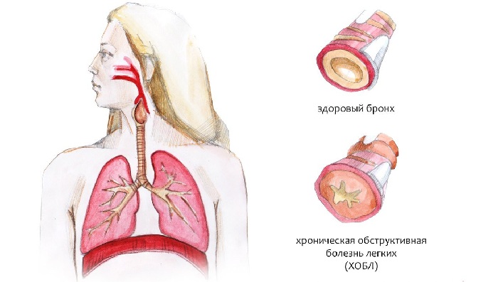 Хронический