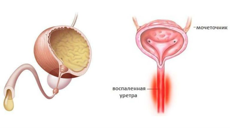 цистит жжение в уретре