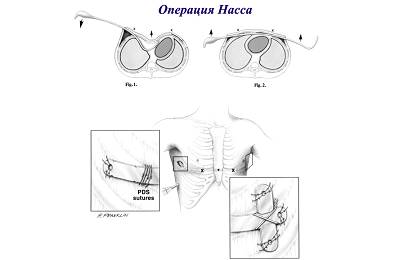 Операция Насса