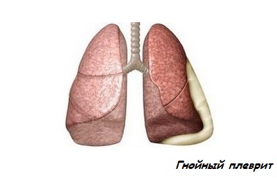 Гнойный плеврит