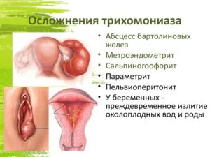 Осложнения трихомониаза