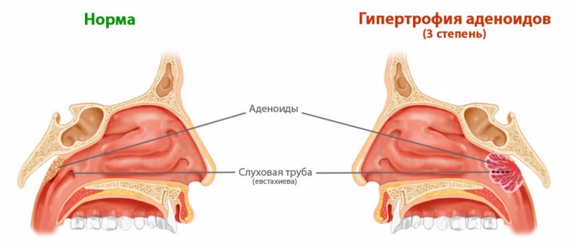 Гипертрофия аденоидов