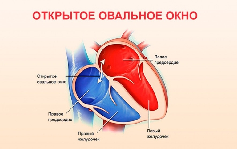 Открытое овальное окно в сердце у детей