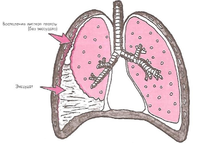 Плевральный выпот