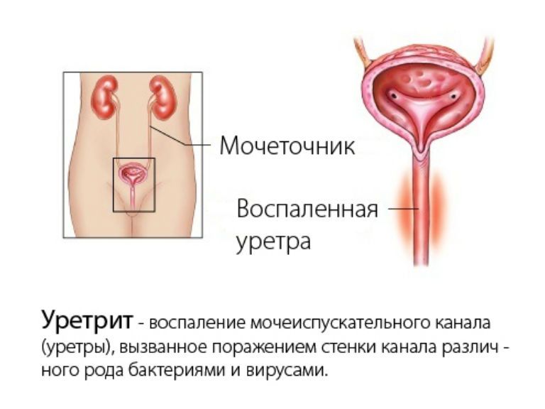после цистита остались неприятные ощущения в уретре